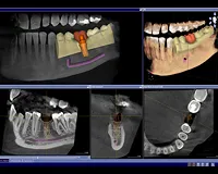 3D images taken by the Sirona 3D Scanner